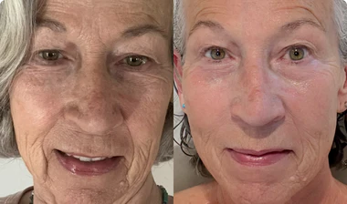 Before and After